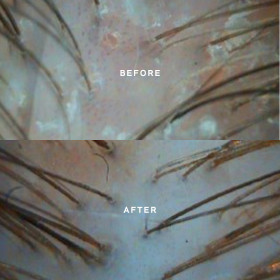 Hair Growth Treatment - Miriam Quevedo