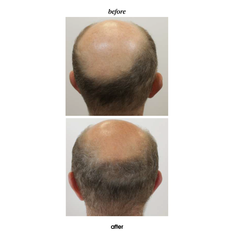 BLACK BACCARA HAIR MULTIPLYING GROWSHOT SCALP CONCENTRATE