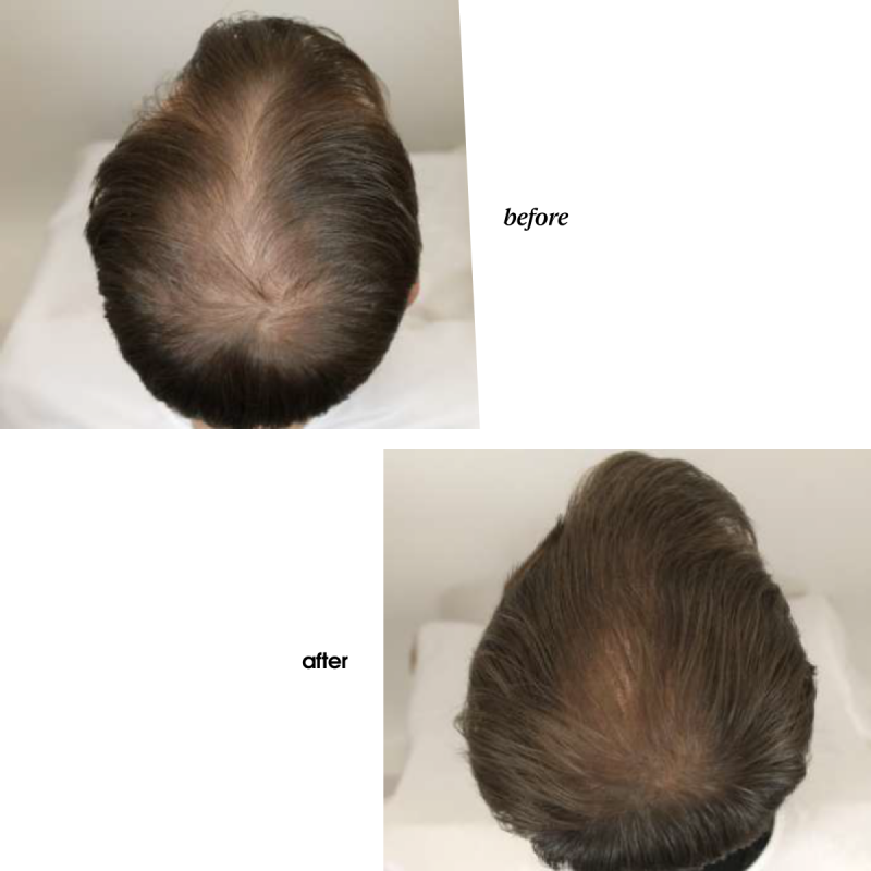 EXTREME CAVIAR REVITALIZING EXOSOMICSHOT SCALP CONCENTRATE
