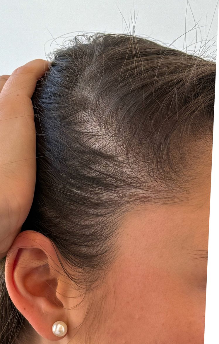 progressive shedding