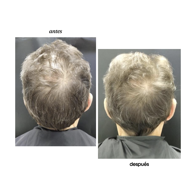 BLACK BACCARA HAIR MULTIPLYING RENEWAL SCALP PEELING